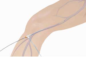 catheter into the diseased vein
